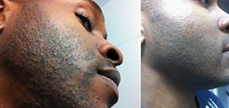 How to get Raid of Razor Bumps – Fwresh Inc